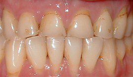 Worn And Stained Teeth Before