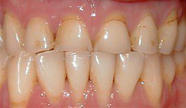 2a Worn And Stained Teeth Before