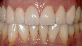 Worn And Stained Teeth After