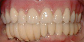 Upper Denture Implant Before