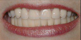 Upper Denture Implant After