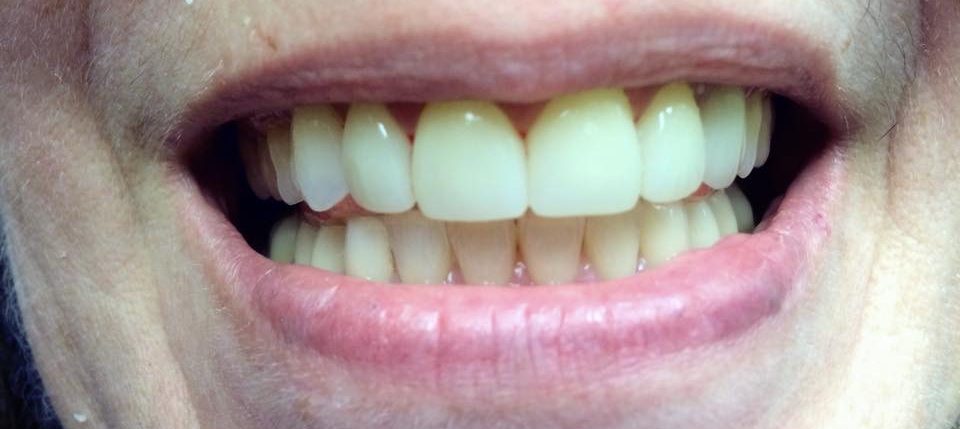 Porcelain Crowns After