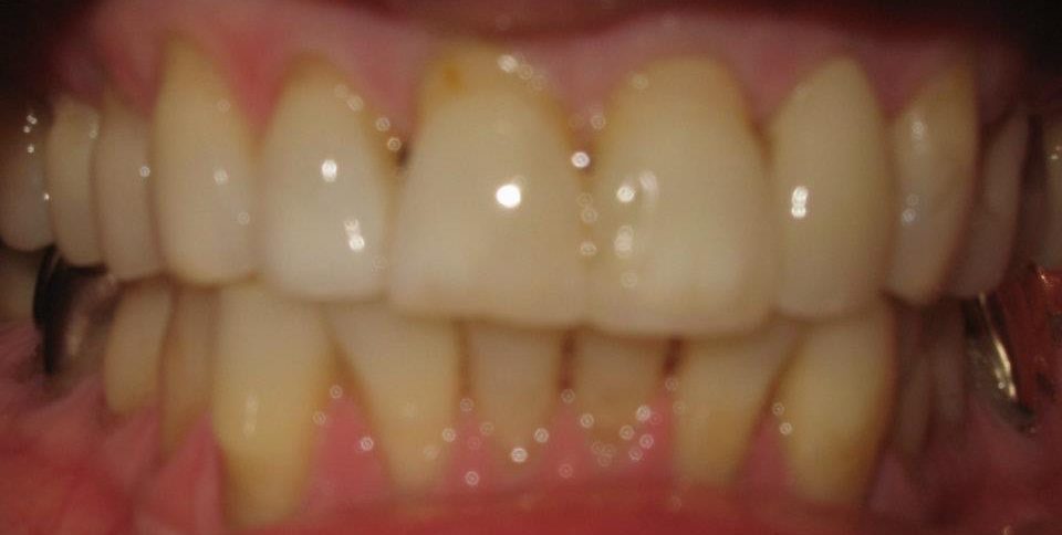 Dental Veneers Before