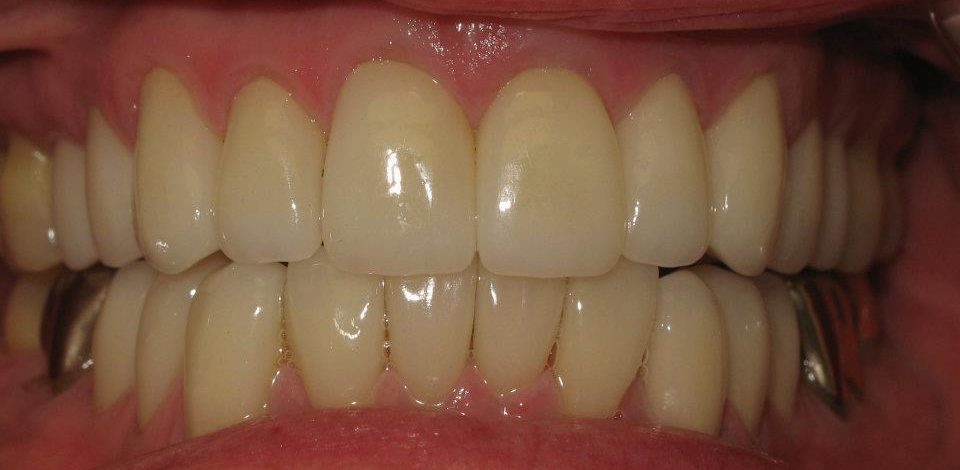 Dental Veneers After