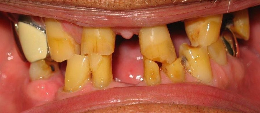 Full Mouth Rehabilitation After